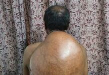 अम्बेडकर अस्पताल के सर्जरी विभाग की ऐतिहासिक उपलब्धि :10.30 किलोग्राम वजनी विशाल ट्यूमर का सफल ऑपरेशन अम्बेडकर अस्पताल के सर्जरी विभाग की ऐतिहासिक उपलब्धि :10.30 किलोग्राम वजनी विशाल ट्यूमर का सफल ऑपरेशन