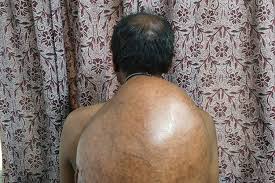 download (2) अम्बेडकर अस्पताल के सर्जरी विभाग की ऐतिहासिक उपलब्धि :10.30 किलोग्राम वजनी विशाल ट्यूमर का सफल ऑपरेशन