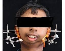 ashif जटिल सर्जरी से खुला मुंह, आयुष्मान योजना से मिला निःशुल्क उपचार